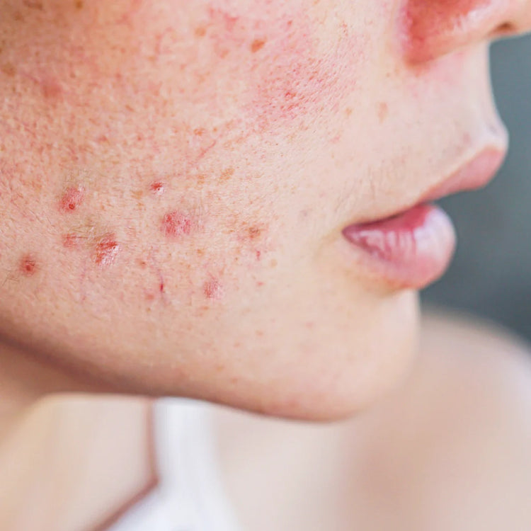 Acne Treatments