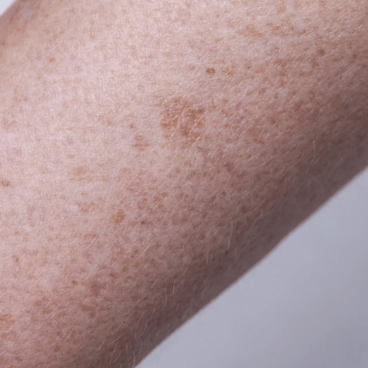Hyperpigmentation